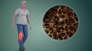 Deporte y osteoporosis